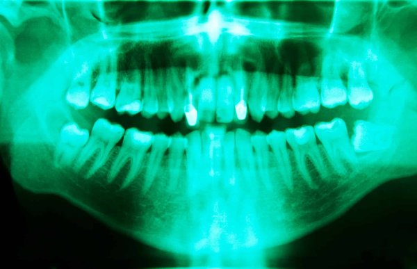 Is There a Connection Between Oral Hygiene and Cardiovascular Diseases?